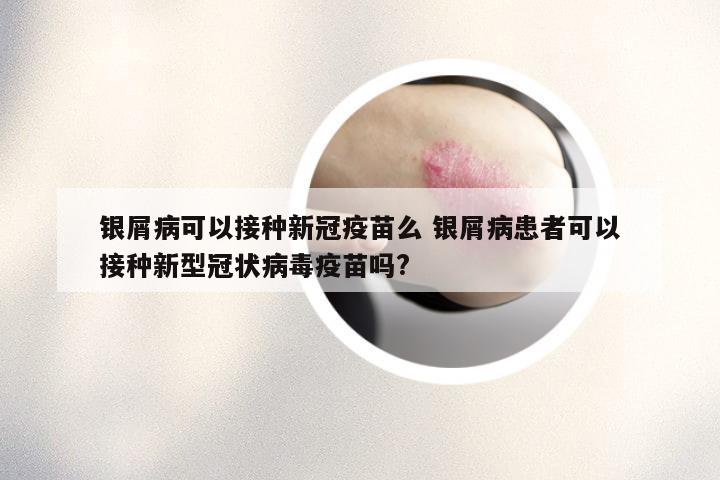 银屑病可以接种新冠疫苗么 银屑病患者可以接种新型冠状病毒疫苗吗?