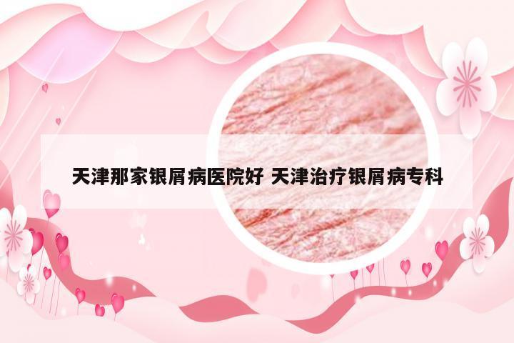 天津那家银屑病医院好 天津治疗银屑病专科