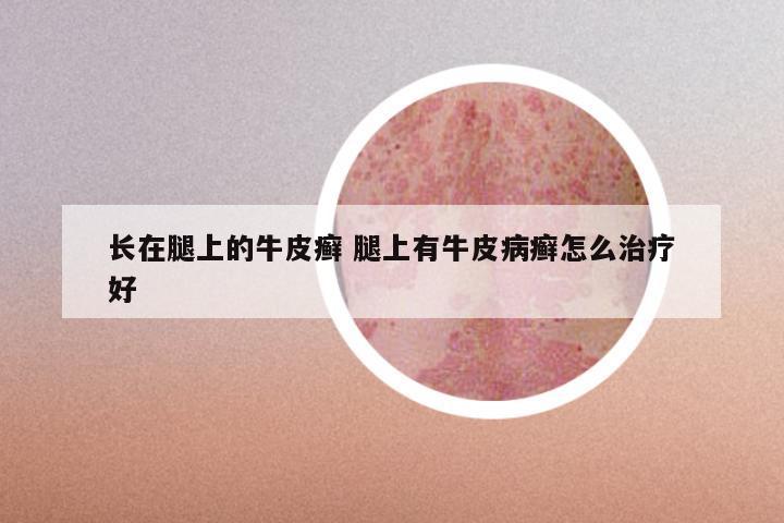 长在腿上的牛皮癣 腿上有牛皮病癣怎么治疗好