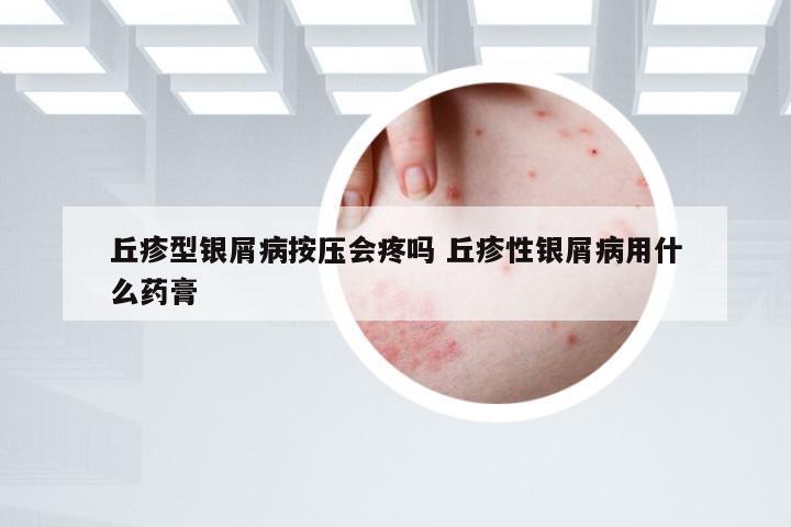 丘疹型银屑病按压会疼吗 丘疹性银屑病用什么药膏