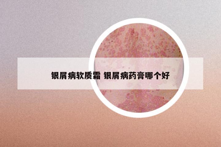 银屑病软质霜 银屑病药膏哪个好
