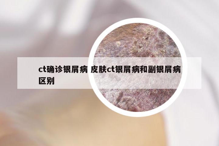 ct确诊银屑病 皮肤ct银屑病和副银屑病区别
