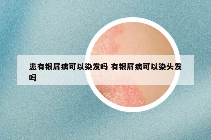 患有银屑病可以染发吗 有银屑病可以染头发吗