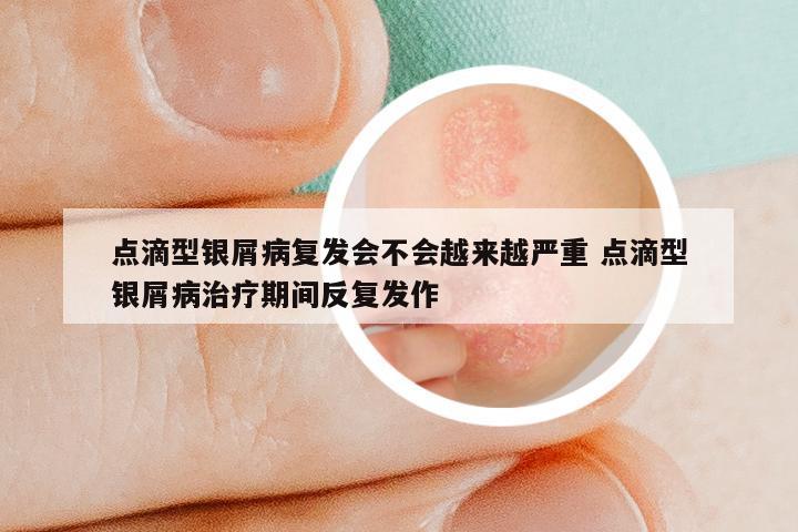 点滴型银屑病复发会不会越来越严重 点滴型银屑病治疗期间反复发作