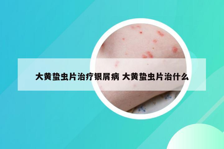大黄蛰虫片治疗银屑病 大黄蛰虫片治什么