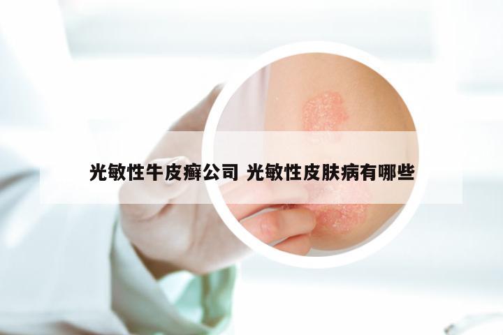 光敏性牛皮癣公司 光敏性皮肤病有哪些