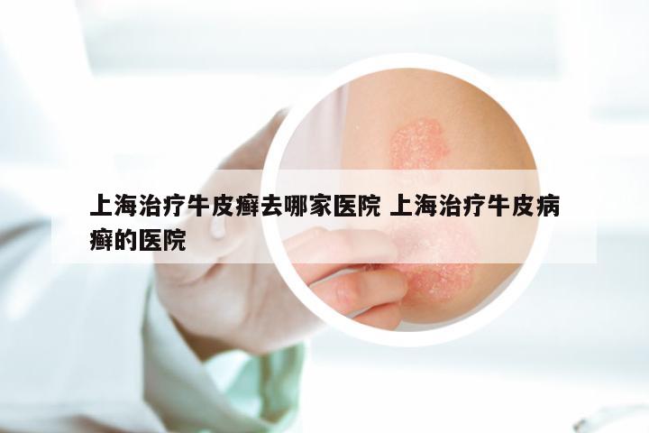 上海治疗牛皮癣去哪家医院 上海治疗牛皮病癣的医院