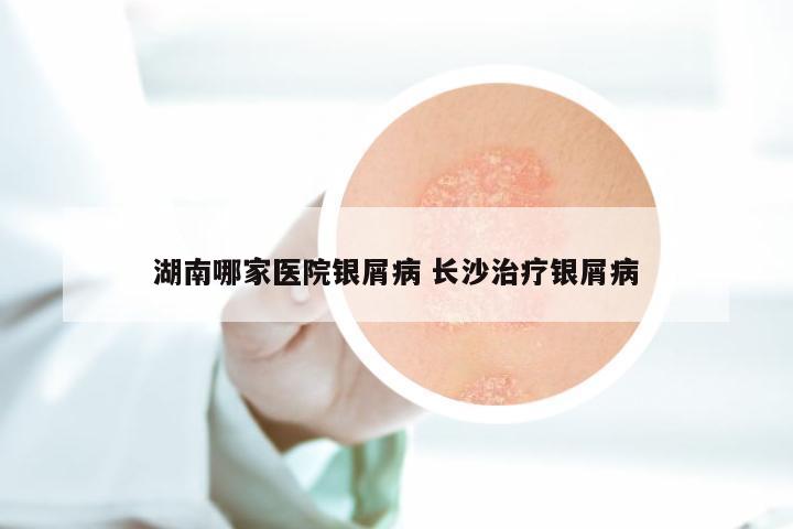 湖南哪家医院银屑病 长沙治疗银屑病
