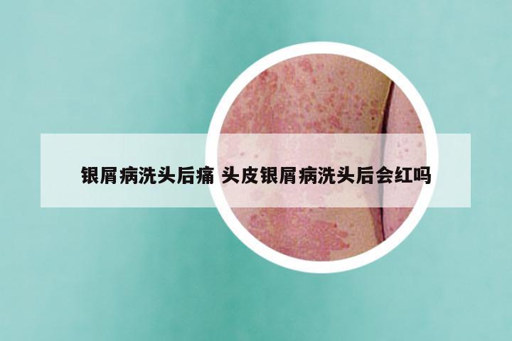 银屑病洗头后痛 头皮银屑病洗头后会红吗