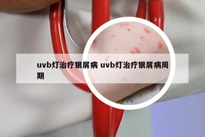 uvb灯治疗银屑病 uvb灯治疗银屑病周期