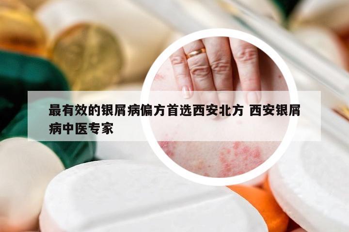 最有效的银屑病偏方首选西安北方 西安银屑病中医专家