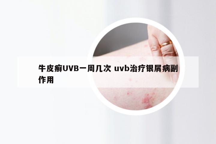牛皮癣UVB一周几次 uvb治疗银屑病副作用