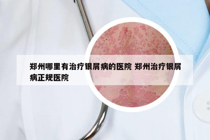 郑州哪里有治疗银屑病的医院 郑州治疗银屑病正规医院