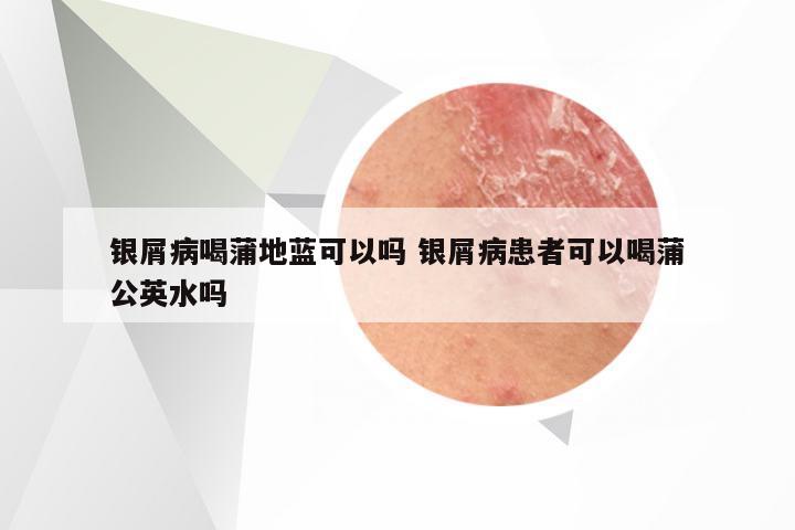 银屑病喝蒲地蓝可以吗 银屑病患者可以喝蒲公英水吗