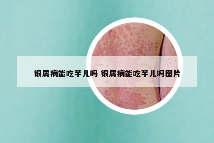 银屑病能吃芋儿吗 银屑病能吃芋儿吗图片