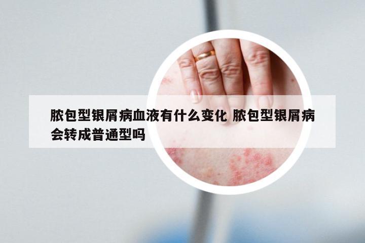 脓包型银屑病血液有什么变化 脓包型银屑病会转成普通型吗