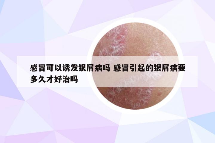 感冒可以诱发银屑病吗 感冒引起的银屑病要多久才好治吗