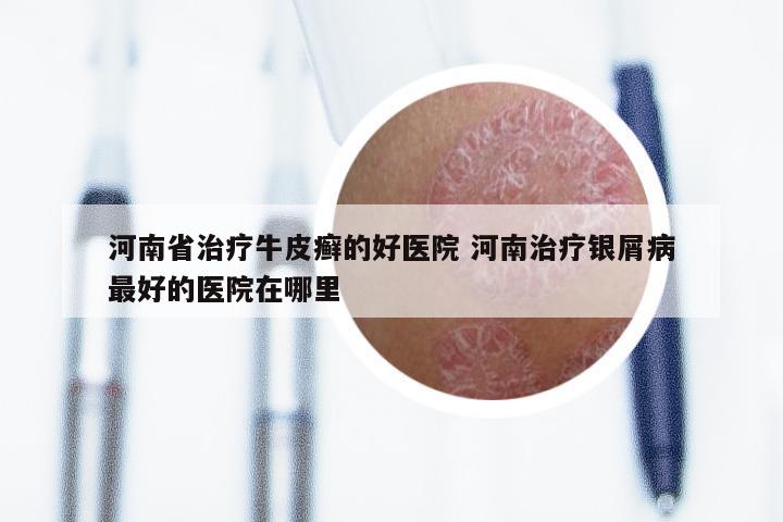 河南省治疗牛皮癣的好医院 河南治疗银屑病最好的医院在哪里