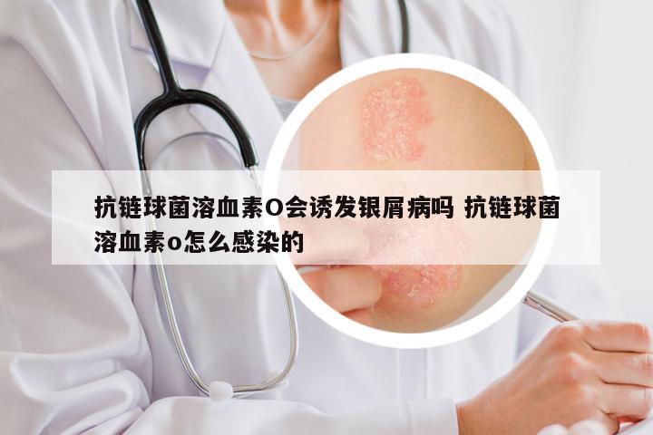 抗链球菌溶血素O会诱发银屑病吗 抗链球菌溶血素o怎么感染的