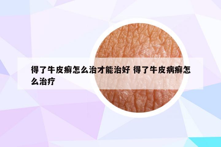 得了牛皮癣怎么治才能治好 得了牛皮病癣怎么治疗