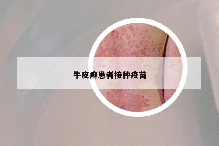 牛皮癣患者接种疫苗