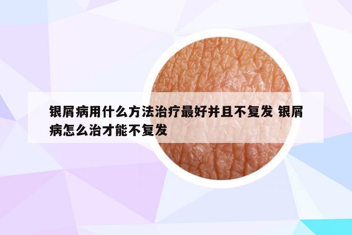 银屑病用什么方法治疗最好并且不复发 银屑病怎么治才能不复发