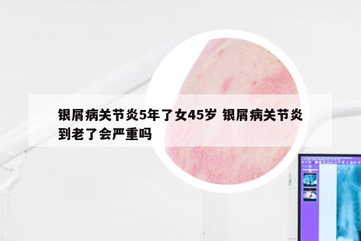 银屑病关节炎5年了女45岁 银屑病关节炎到老了会严重吗