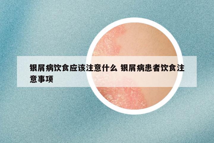银屑病饮食应该注意什么 银屑病患者饮食注意事项