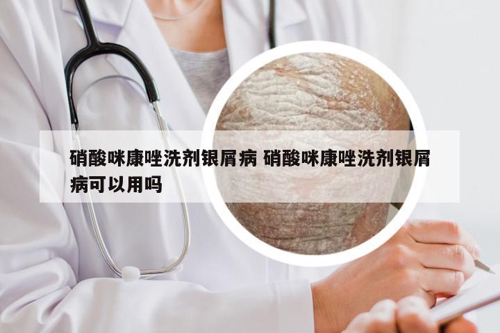 硝酸咪康唑洗剂银屑病 硝酸咪康唑洗剂银屑病可以用吗