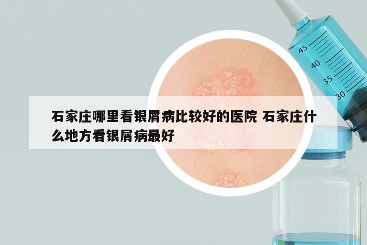 石家庄哪里看银屑病比较好的医院 石家庄什么地方看银屑病最好
