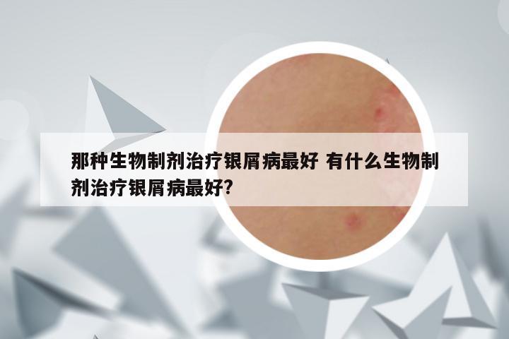 那种生物制剂治疗银屑病最好 有什么生物制剂治疗银屑病最好?
