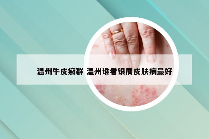 温州牛皮癣群 温州谁看银屑皮肤病最好