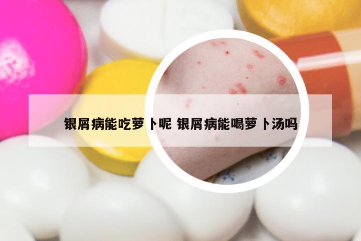 银屑病能吃萝卜呢 银屑病能喝萝卜汤吗