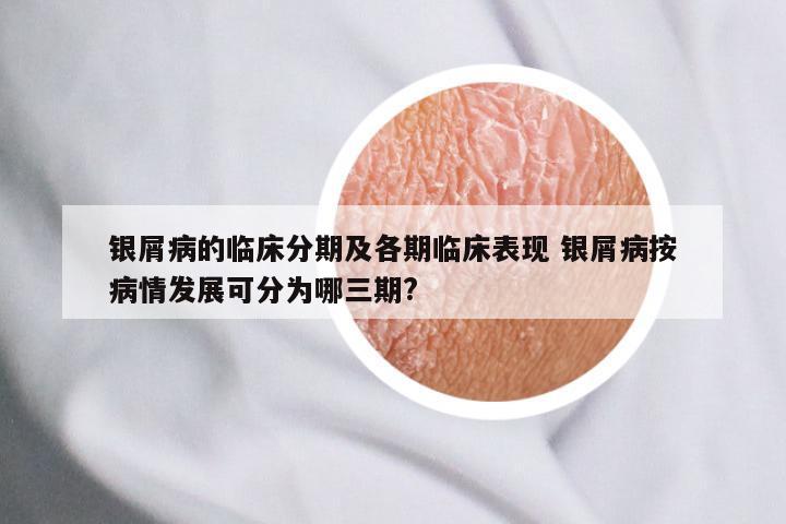 银屑病的临床分期及各期临床表现 银屑病按病情发展可分为哪三期?