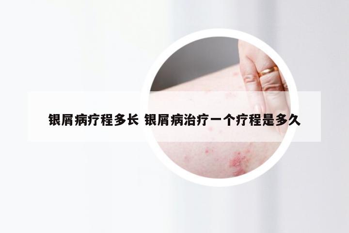 银屑病疗程多长 银屑病治疗一个疗程是多久