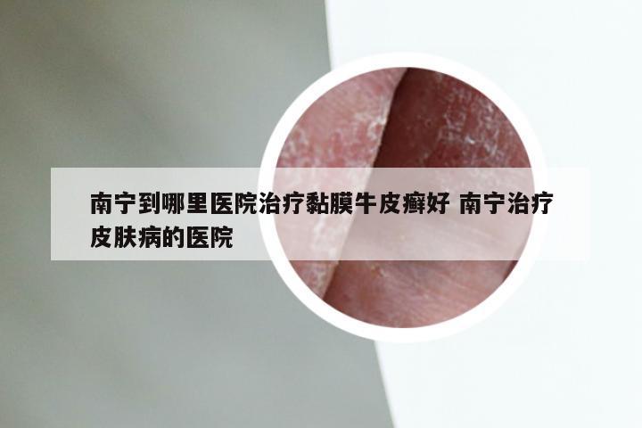 南宁到哪里医院治疗黏膜牛皮癣好 南宁治疗皮肤病的医院