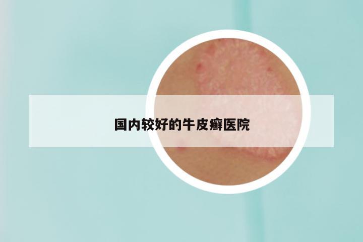 国内较好的牛皮癣医院