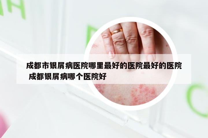 成都市银屑病医院哪里最好的医院最好的医院 成都银屑病哪个医院好