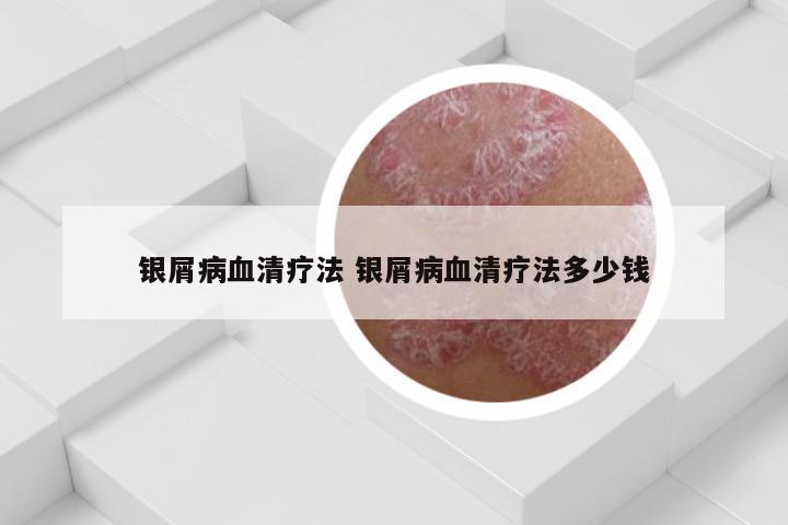 银屑病血清疗法 银屑病血清疗法多少钱