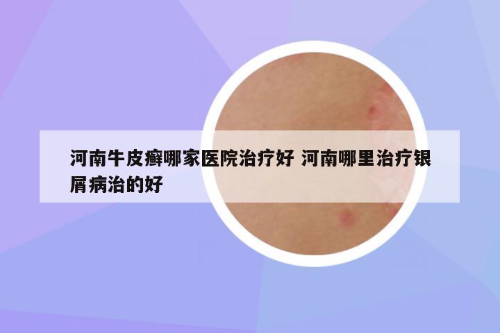 河南牛皮癣哪家医院治疗好 河南哪里治疗银屑病治的好