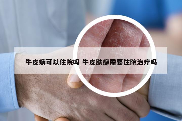 牛皮癣可以住院吗 牛皮肤癣需要住院治疗吗