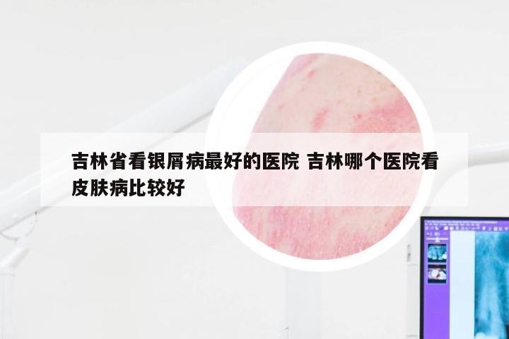 吉林省看银屑病最好的医院 吉林哪个医院看皮肤病比较好