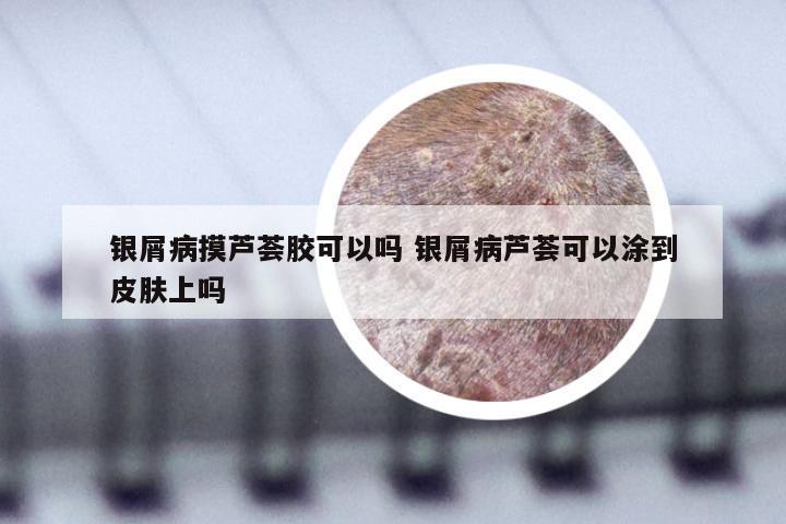 银屑病摸芦荟胶可以吗 银屑病芦荟可以涂到皮肤上吗