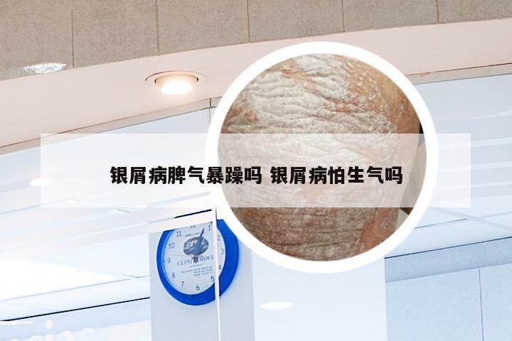 银屑病脾气暴躁吗 银屑病怕生气吗