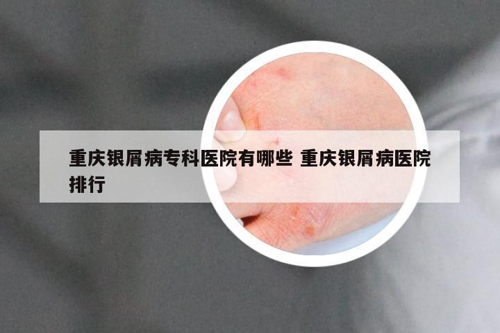 重庆银屑病专科医院有哪些 重庆银屑病医院排行