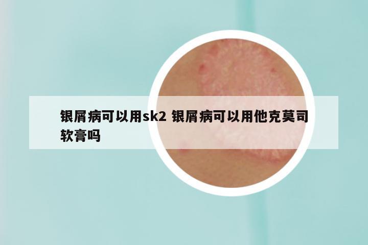 银屑病可以用sk2 银屑病可以用他克莫司软膏吗