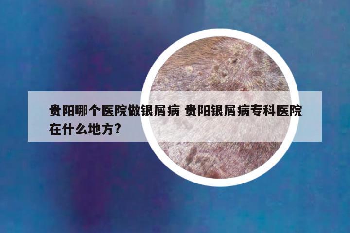 贵阳哪个医院做银屑病 贵阳银屑病专科医院在什么地方?
