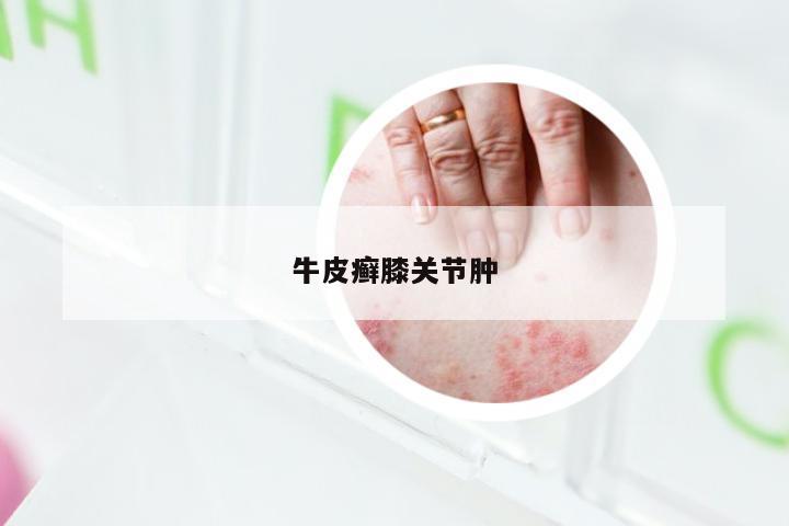 牛皮癣膝关节肿