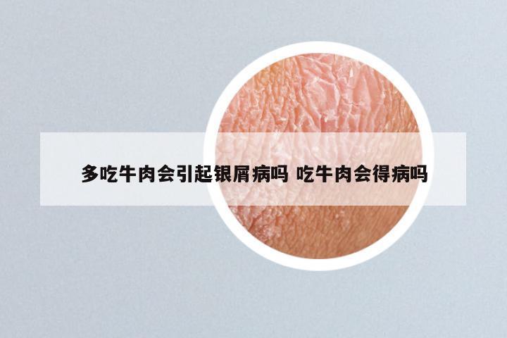 多吃牛肉会引起银屑病吗 吃牛肉会得病吗