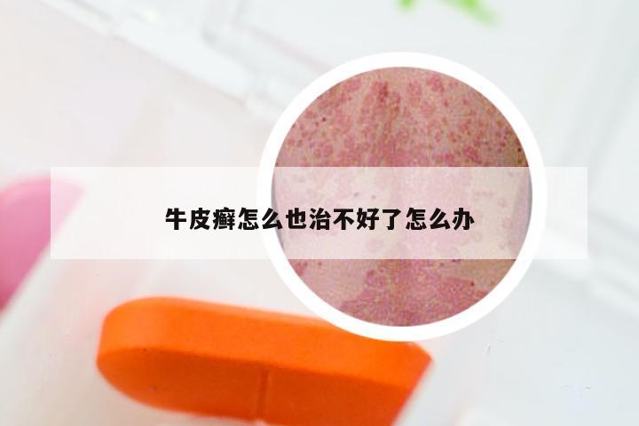 牛皮癣怎么也治不好了怎么办